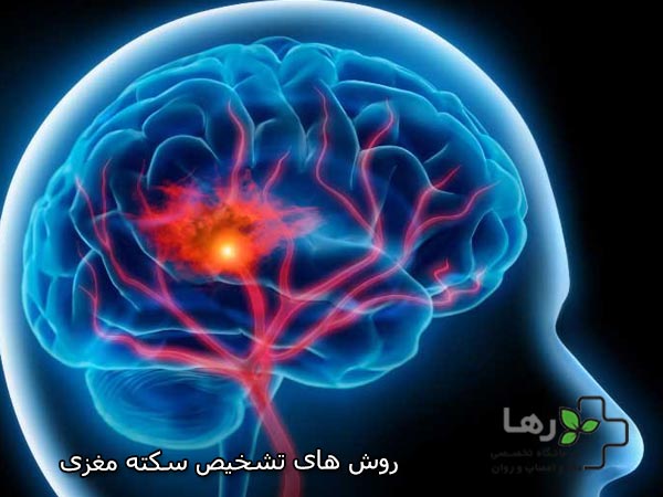 روش های تشخیص سکته مغزی