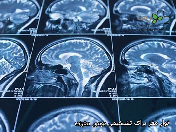 نوار مغز برای تشخیص تومور تهران