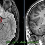 تشخیص تومور با نوار مغز
