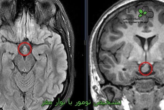 تشخیص-تومور-با-نوار-مغز.jpg
